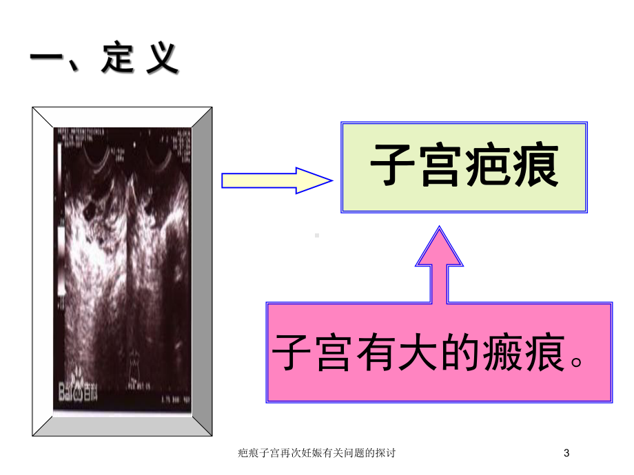 疤痕子宫再次妊娠有关问题的探讨培训课件.ppt_第3页