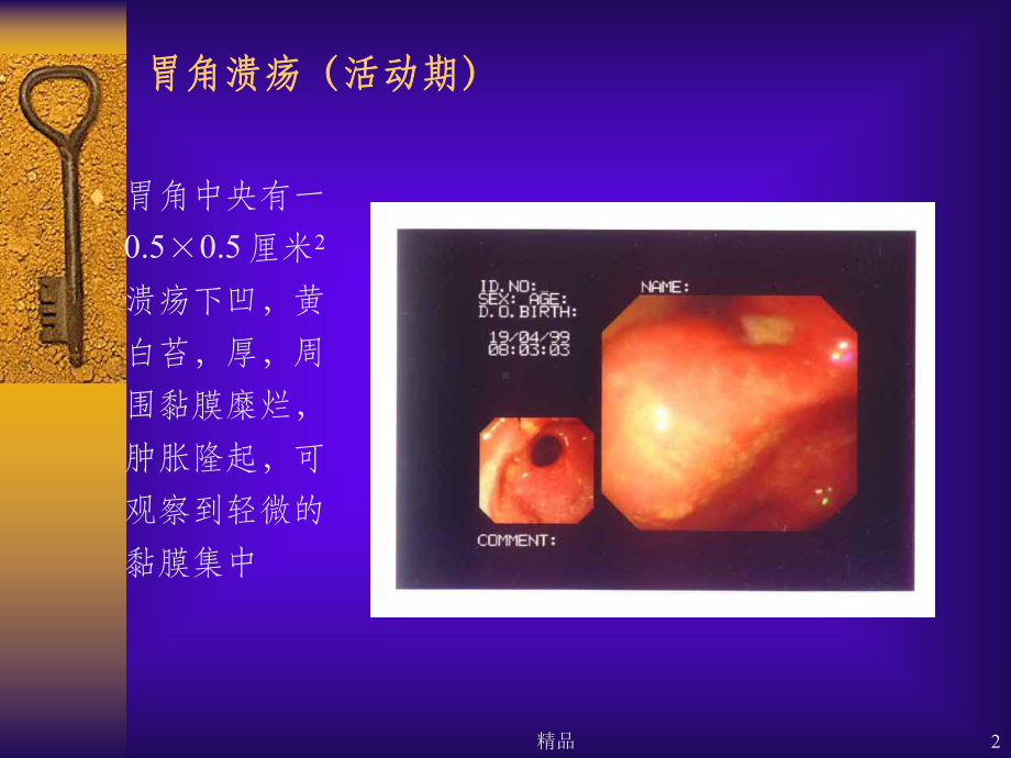 消化性溃疡详解(含图)课件.ppt_第2页