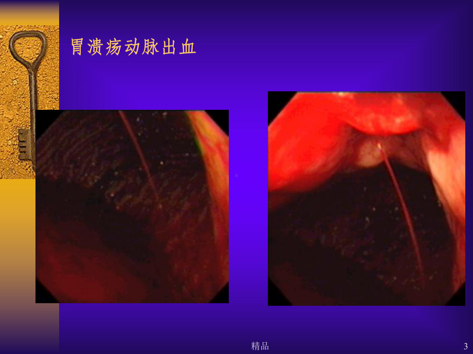 消化性溃疡详解(含图)课件.ppt_第3页