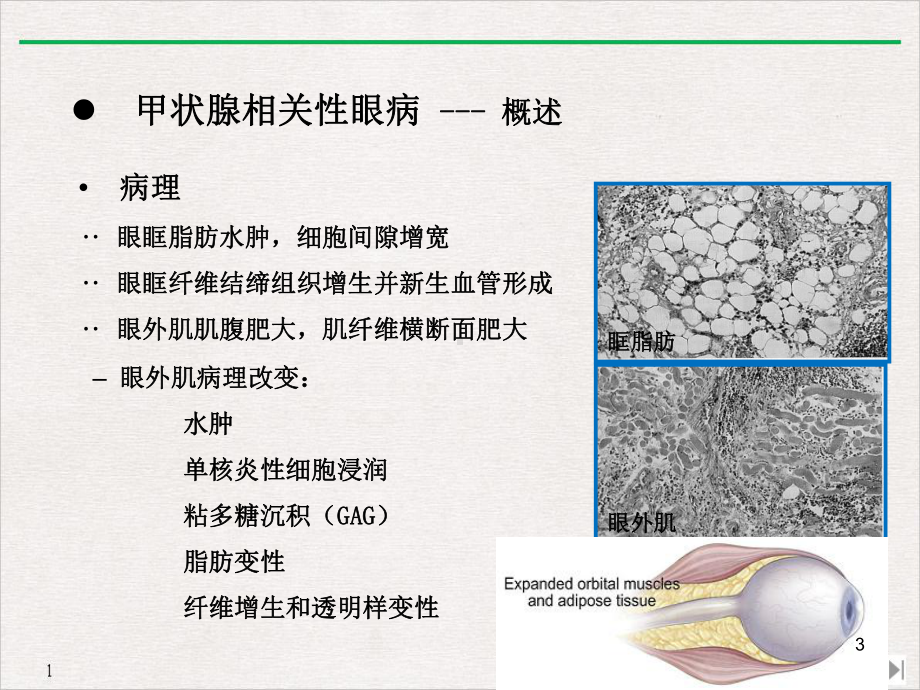 甲状腺相关性眼病影像学表现课件-2.ppt_第3页