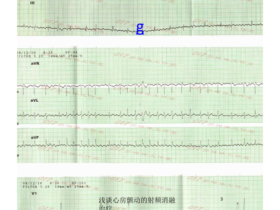 浅谈心房颤动的射频消融治疗培训课件.ppt_第3页