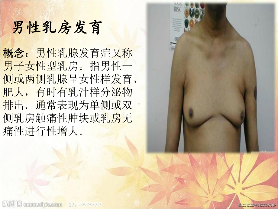 男性乳腺发育护理查房课件.ppt_第3页