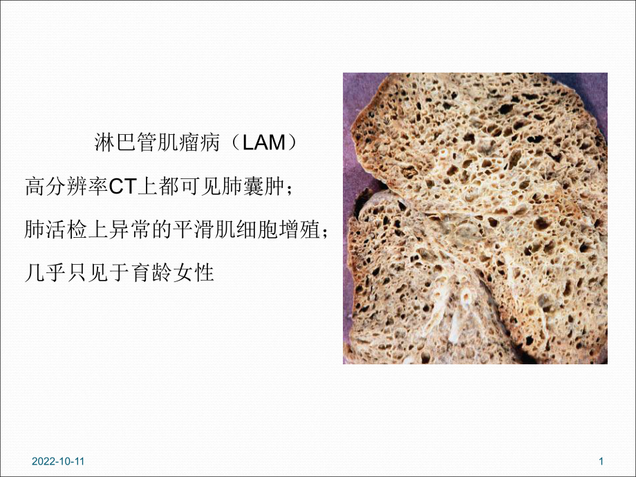 淋巴管肌瘤病的肺部CT表现参考课件.ppt_第1页