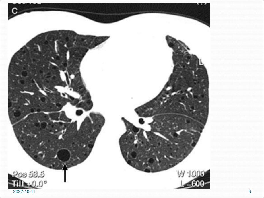 淋巴管肌瘤病的肺部CT表现参考课件.ppt_第3页