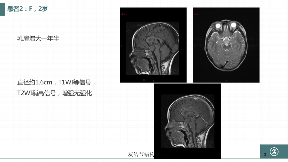 灰结节错构瘤培训课件.ppt_第3页