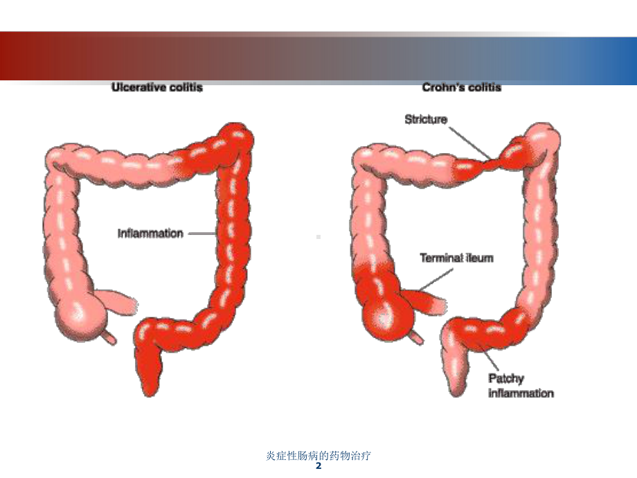 炎症性肠病的药物治疗培训课件.ppt_第2页