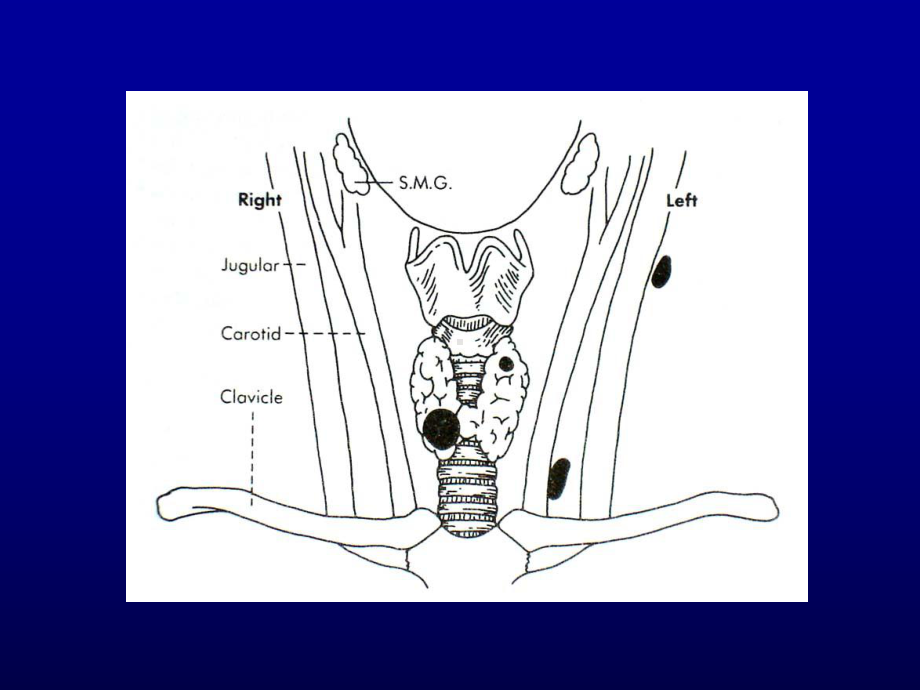 甲状腺机能亢进症-Hyperthyroidism课件.ppt_第2页