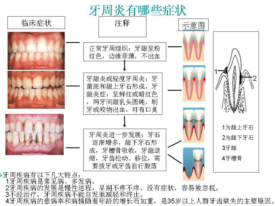 牙周炎的分类及临床表现培训课件.ppt_第1页