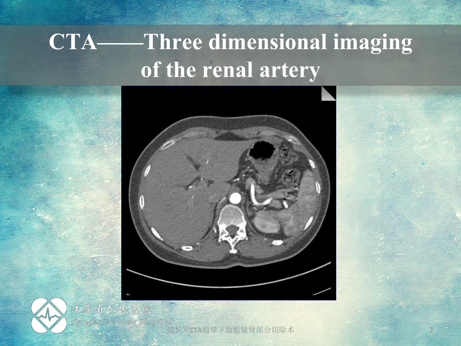 殷长军CTA指导下腹腔镜肾部分切除术课件.ppt_第2页