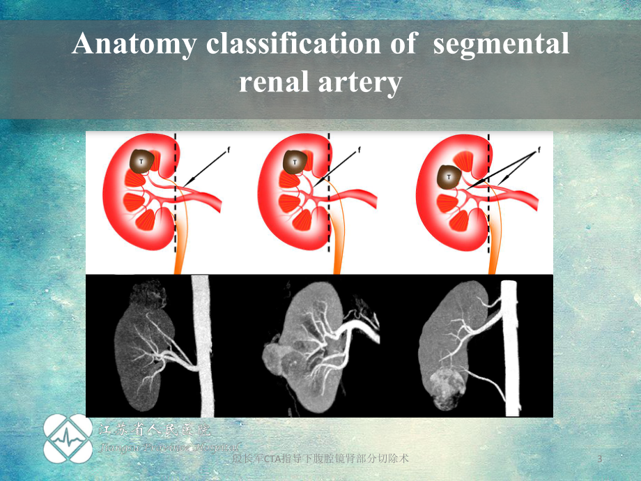 殷长军CTA指导下腹腔镜肾部分切除术课件.ppt_第3页