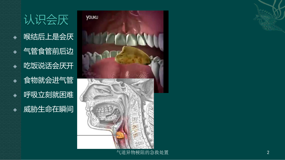 气道异物梗阻的急救处置培训课件.ppt_第2页