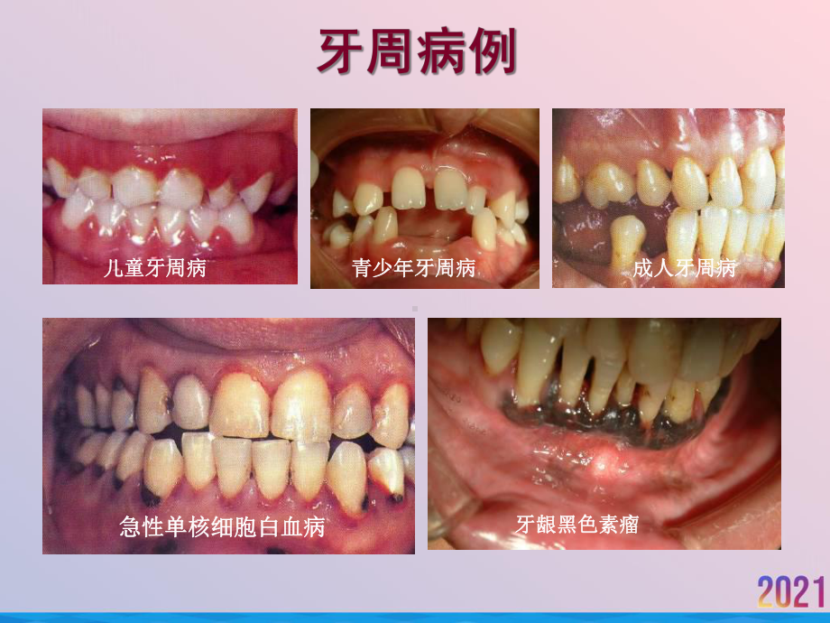 牙周病的临床治疗现状课件.ppt_第3页