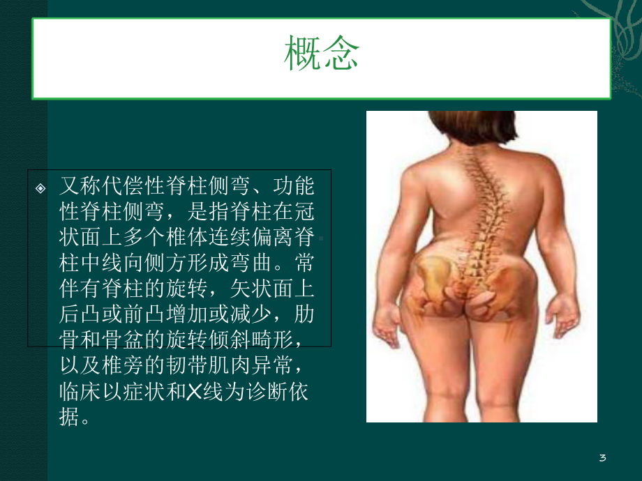 特发性脊柱侧弯教学课件.ppt_第3页