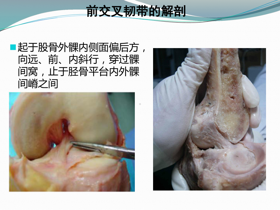 浅谈前交叉韧带损伤课件.pptx_第3页