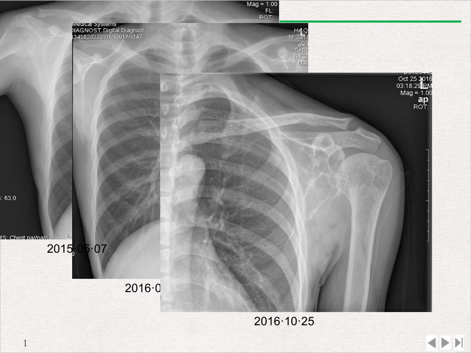 甲状旁腺激素亢进骨病病例讨论及鉴别诊断课件.ppt_第3页