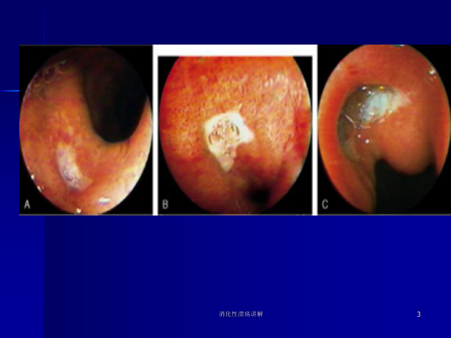 消化性溃疡讲解培训课件.ppt_第3页