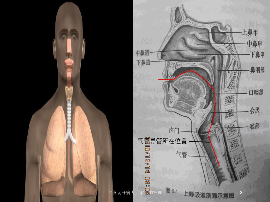 气管切开病人手术后的护理培训课件.ppt_第3页