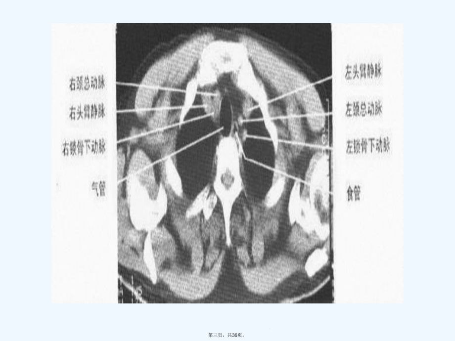 正常胸部CT解剖课件.ppt_第3页