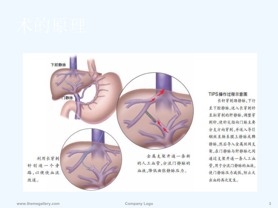 TIPS在门脉高压患者中的临床应用.ppt_第3页