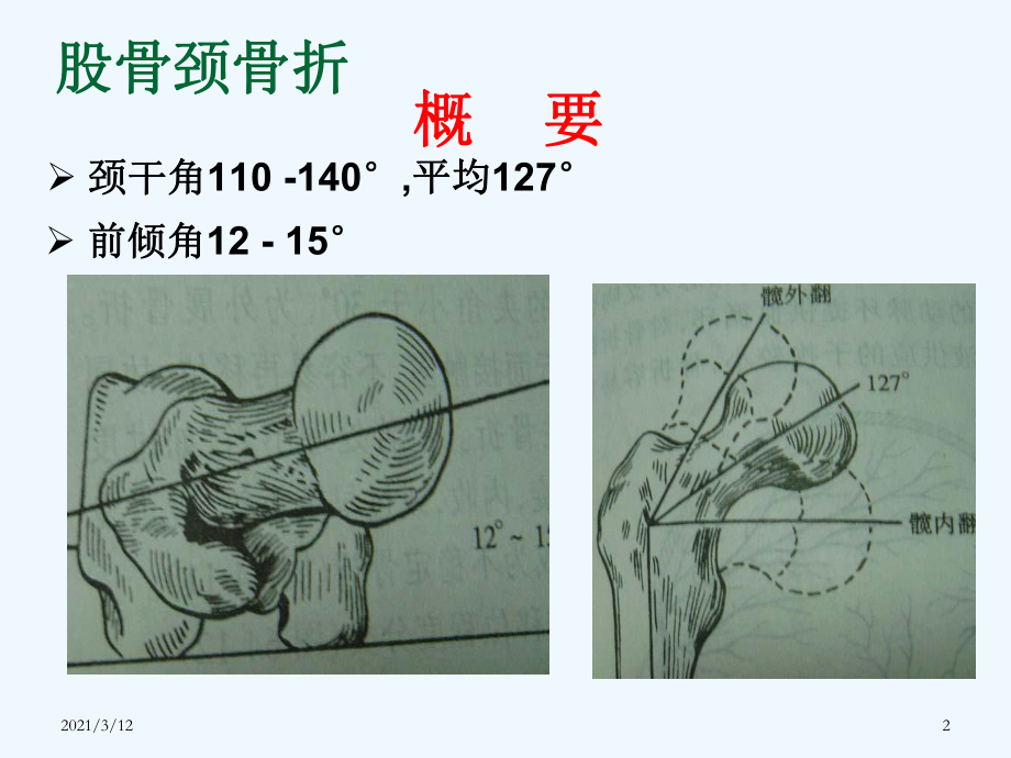 浅谈股骨颈骨折康复课件.ppt_第2页