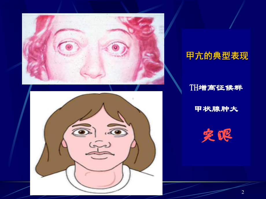 甲状腺相关性眼病课件.ppt_第2页