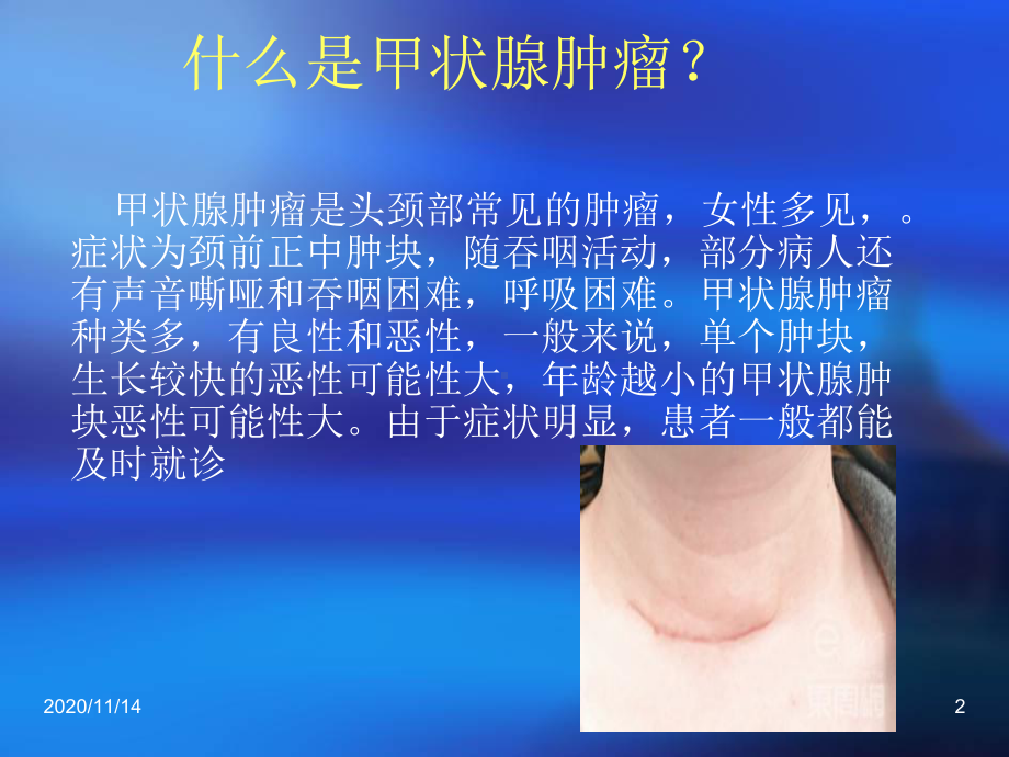 甲状腺瘤护理查房课件.ppt_第2页