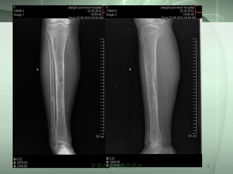 甲旁亢纤维囊性骨炎培训课件.ppt_第2页