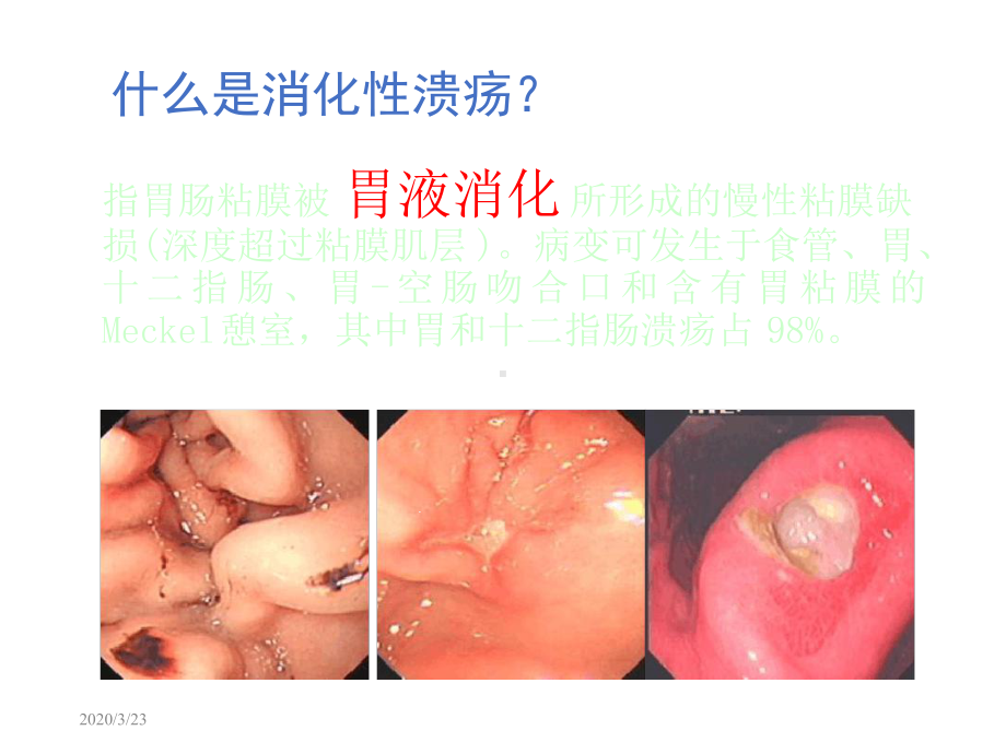 消化性溃疡教学[文字可编辑]课件.ppt_第2页