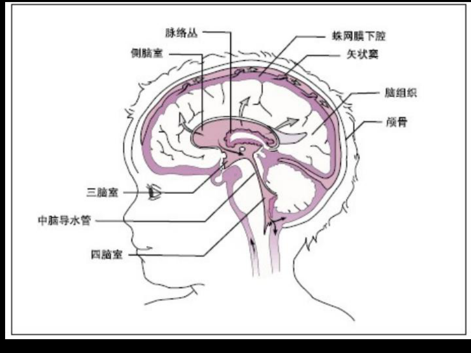 珠网膜下腔出血课件-2.ppt_第3页