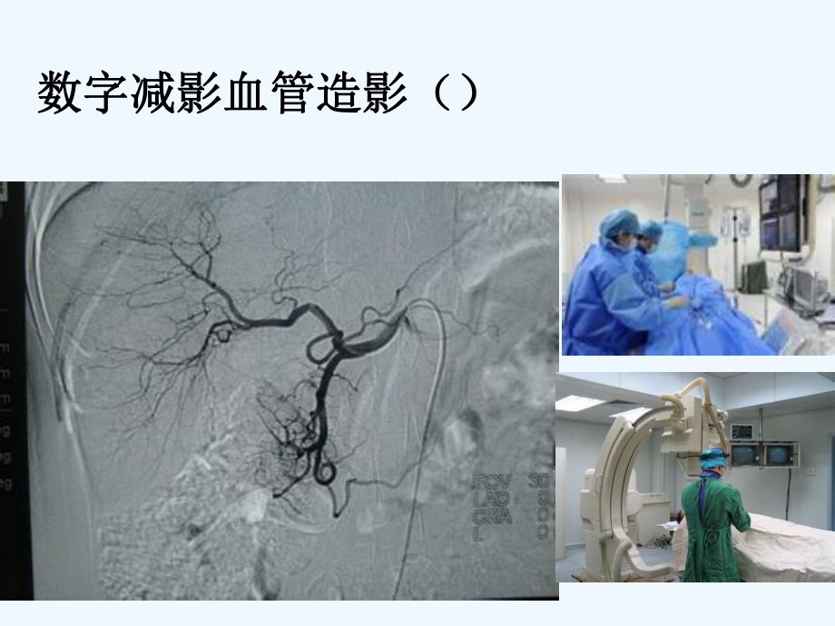 介入放射学第三章-经导管血管栓塞与灌注术.ppt_第2页