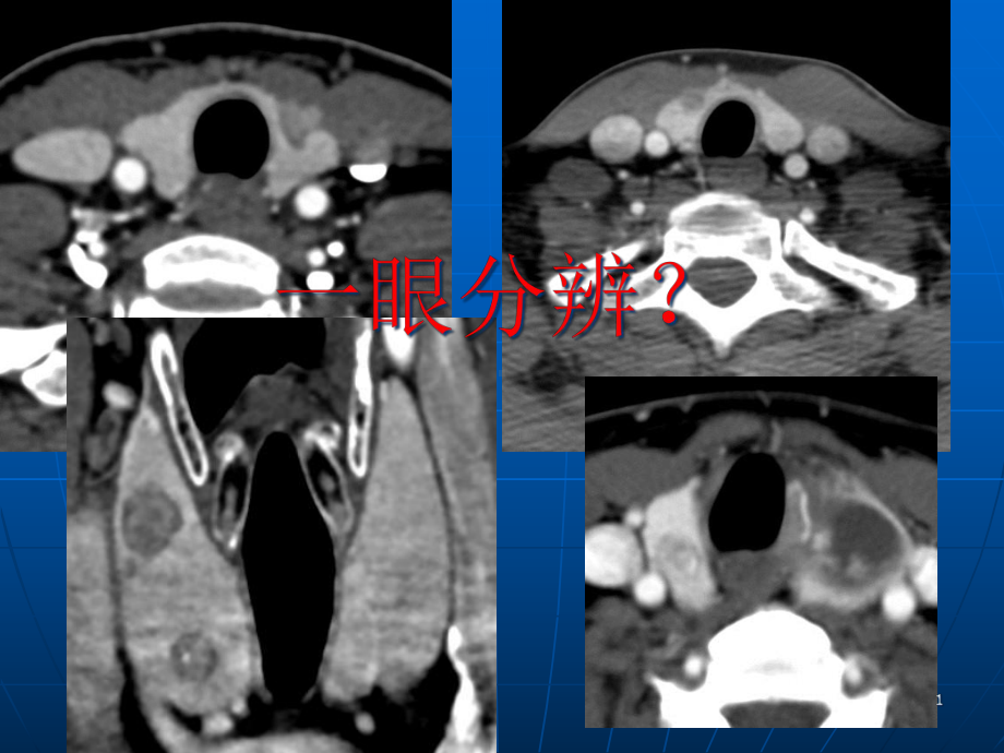 甲状腺乳头状癌CT征象课件.ppt_第1页