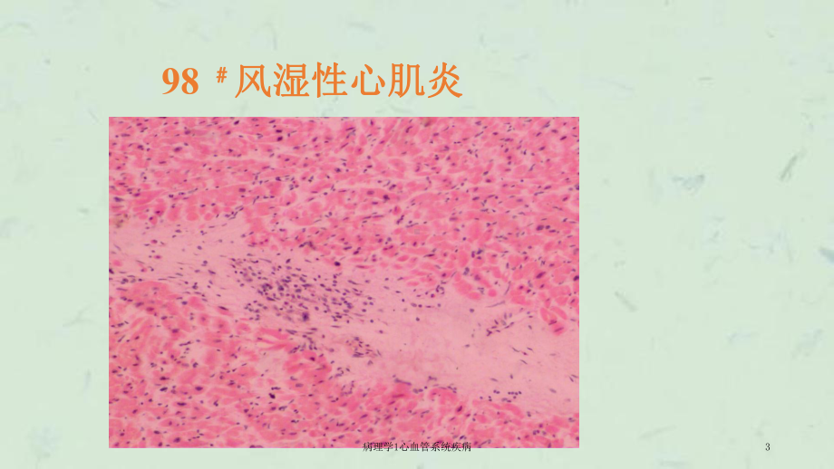 病理学1心血管系统疾病课件.ppt_第3页