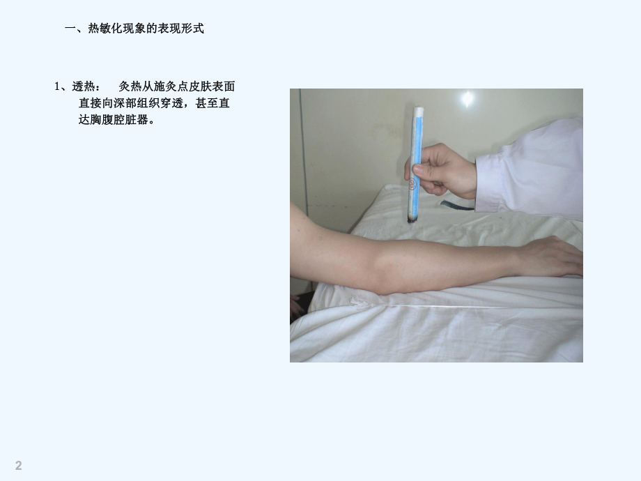 热敏灸疗法治疗腰突症课件.ppt_第2页