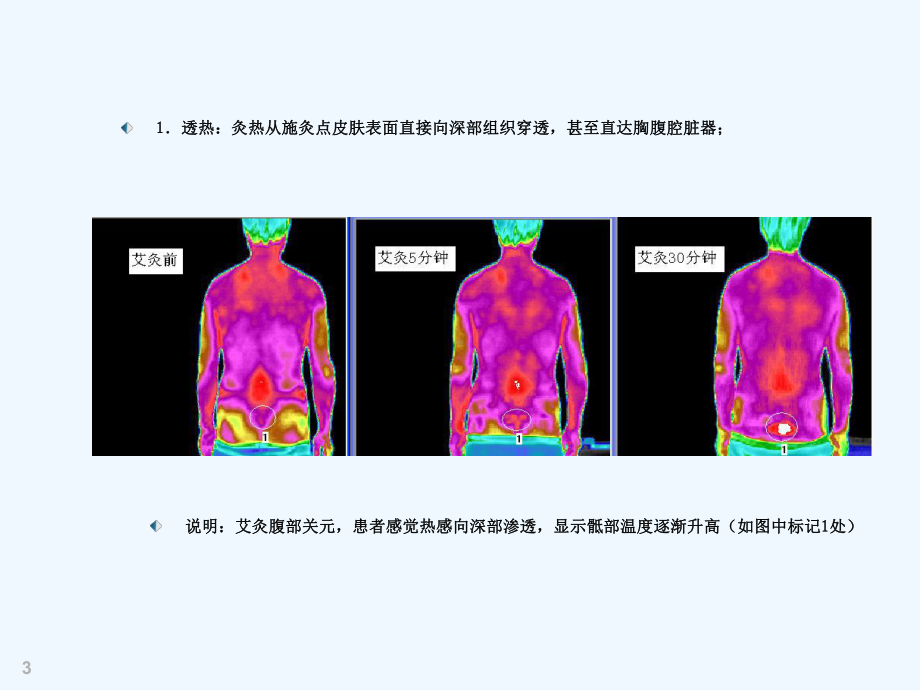 热敏灸疗法治疗腰突症课件.ppt_第3页