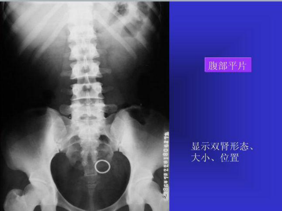 泌尿系统正常解剖结构及结石的X线诊断课件完整版.pptx_第2页