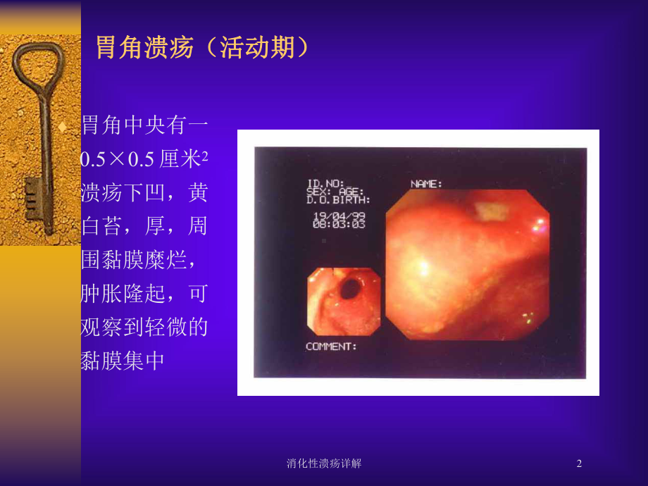 消化性溃疡详解培训课件.ppt_第2页