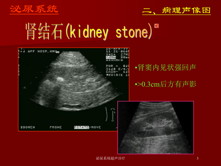 泌尿系统超声诊疗培训课件.ppt_第3页