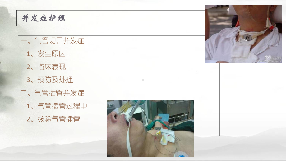 气管切开与气管插管护理教材课件.ppt_第2页