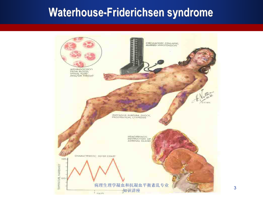 病理生理学凝血和抗凝血平衡紊乱专业知识讲座培训课件.ppt_第3页