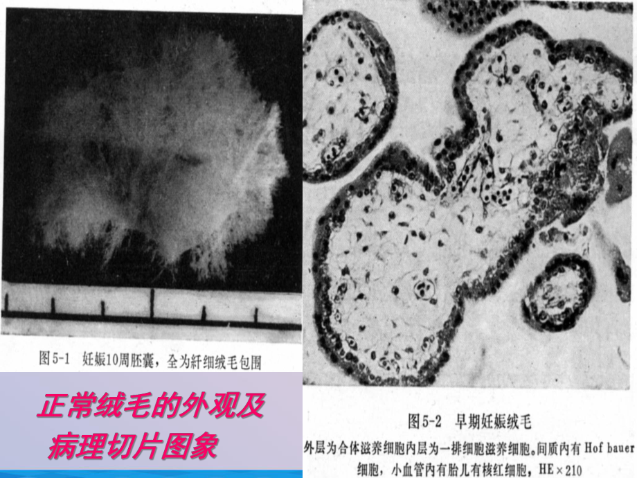 滋养细胞疾病病人的护理课件-2.ppt_第3页