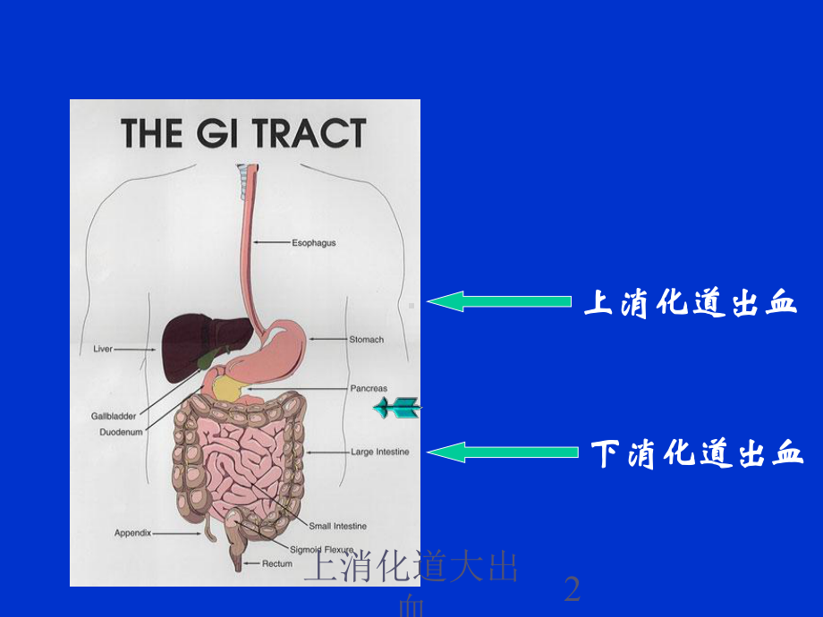 上消化道大出血培训课件1.ppt_第2页