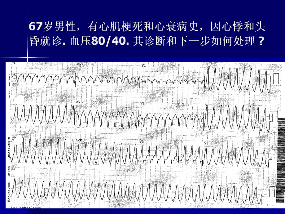 室性心动过速诊断处理 可达龙 peng课件.pptx_第2页