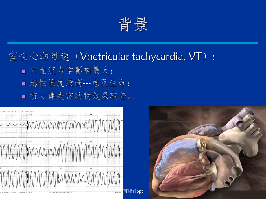 室速的诊断及治疗课件.ppt_第2页