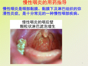 慢性咽炎的用药指导 课件.ppt