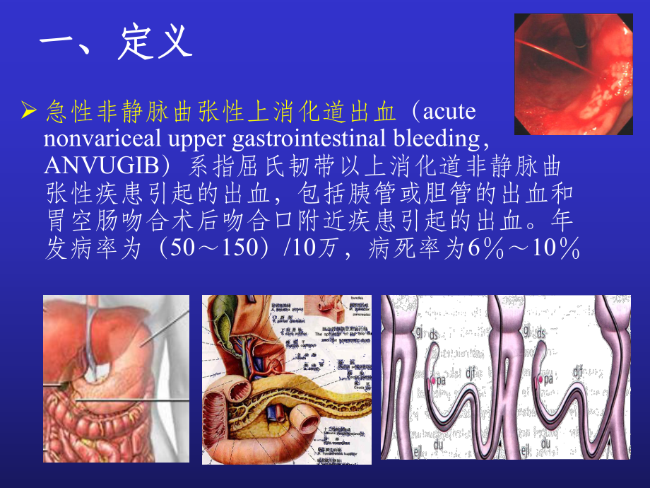 急性非静脉曲张性上消化道出血指南课件.ppt_第2页