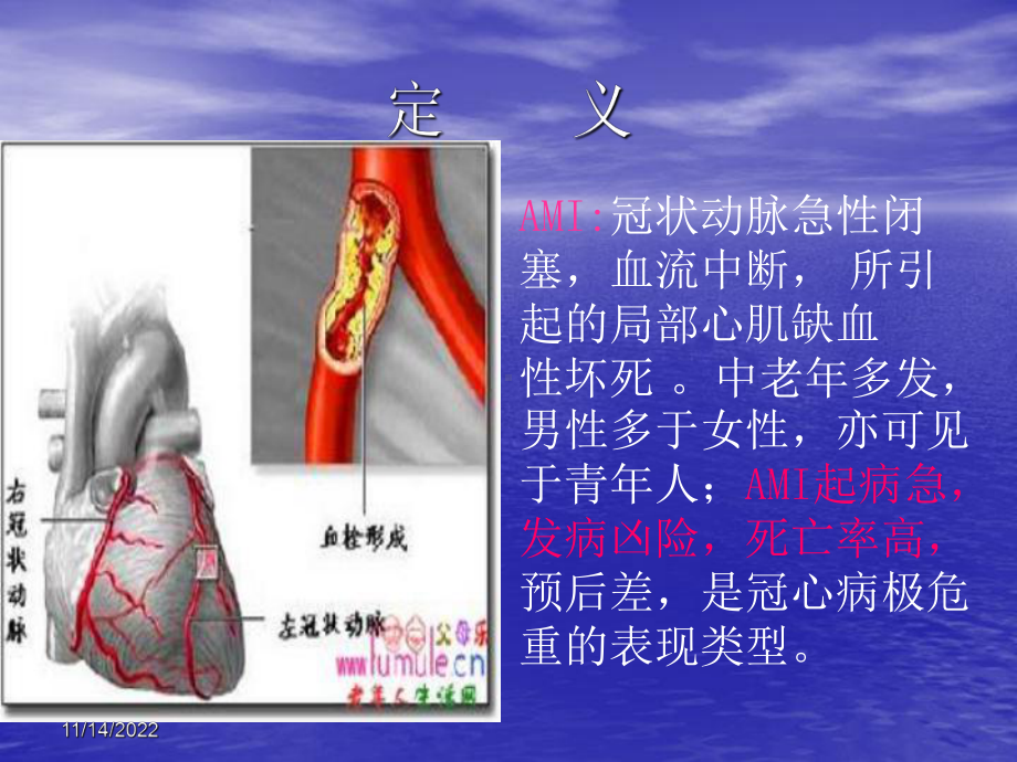 急性心肌梗死的护理新进展讲稿课件.ppt_第2页