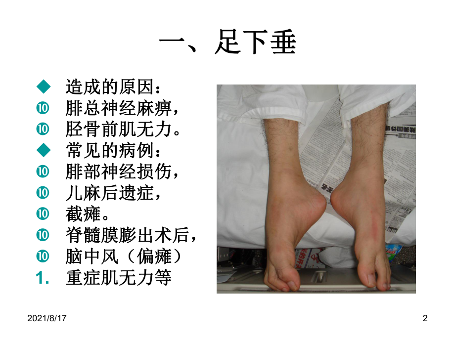 异常体征与矫形器应用课件.ppt_第2页