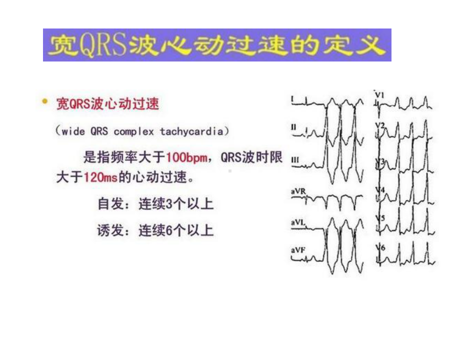 宽QRS-波心动过速鉴别诊断流程课件.pptx_第2页