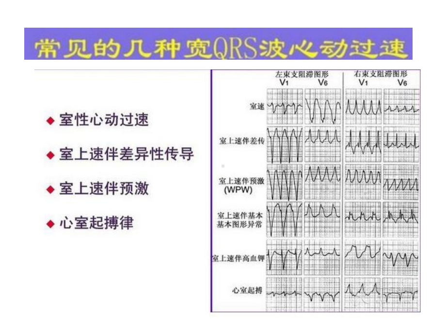 宽QRS-波心动过速鉴别诊断流程课件.pptx_第3页