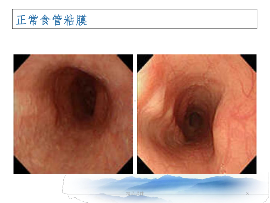 常见消化系统疾病的内镜诊断精选课件.ppt_第3页